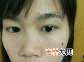 点痣后要注意什么,激光点痣后要注意什么