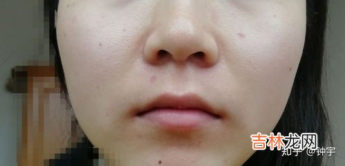 点痣后要注意什么,激光点痣后要注意什么