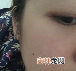 点痣后要注意什么,激光点痣后要注意什么