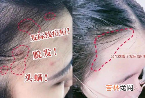 花露水能除螨虫吗,花露水能除螨虫吗 如何消灭螨虫