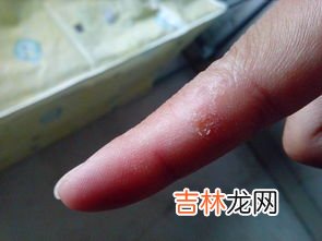 手指烧伤皮掉了怎么办,手被开水烫了.有点脱皮怎么办