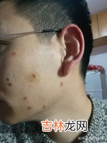 点痣后不能吃什么,点痣之后不要吃什么？