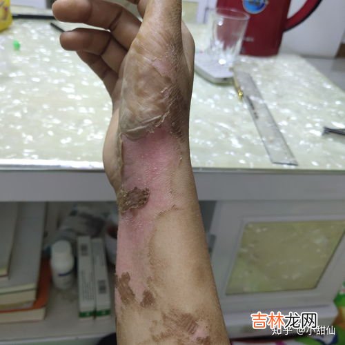 炒菜油烫伤了怎么处理,一做饭就伤痕累累,被热油烫伤,正确的处理方法是什么?