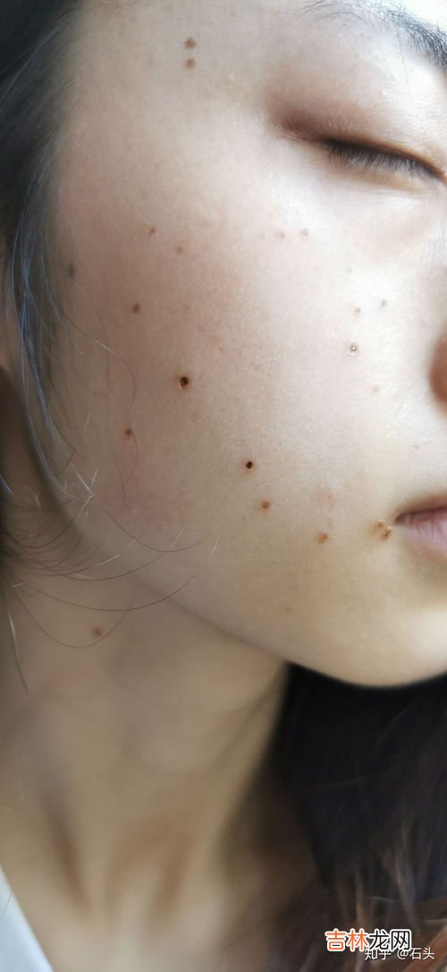 点痣后可以吃鸡蛋吗,激光做太田痣术后可以吃鸡蛋吗?