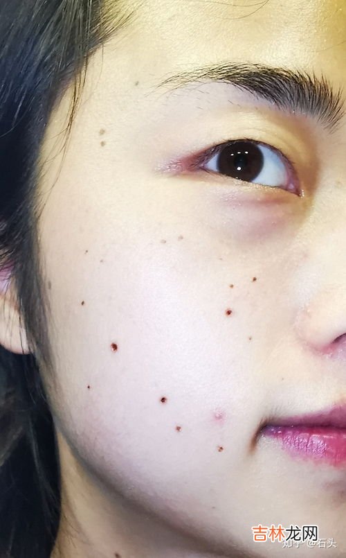 点痣后可以吃鸡蛋吗,激光做太田痣术后可以吃鸡蛋吗?