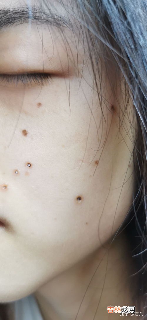 点痣后可以吃鸡蛋吗,激光做太田痣术后可以吃鸡蛋吗?