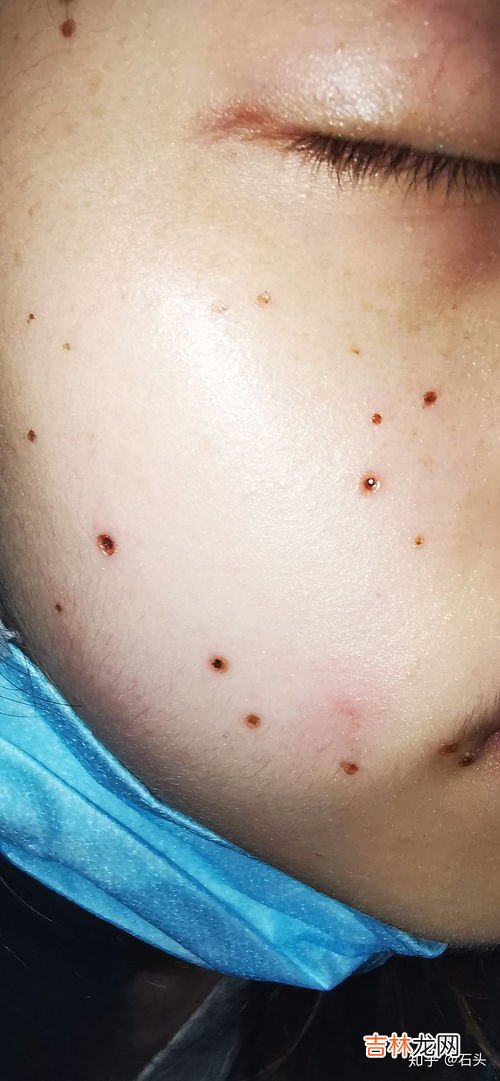 点痣后可以吃鸡蛋吗,激光做太田痣术后可以吃鸡蛋吗?