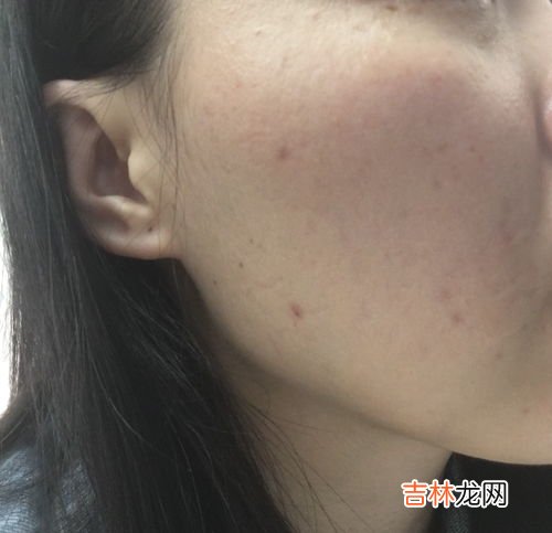 点痣后怎么修复,点痣之后吃什么有助于修复