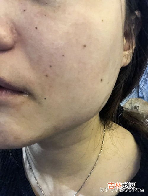 点痣后怎么修复,点痣之后吃什么有助于修复