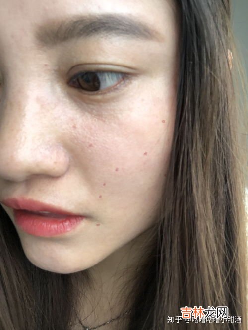 点痣后多久可以化妆,激光点痣多久可以化妆？