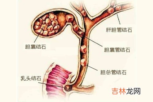 结石是怎样形成的,结石是怎么形成的？