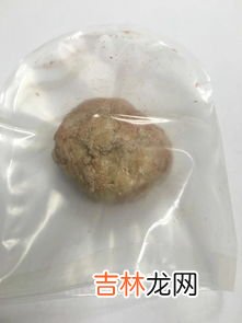 结石是怎样形成的,结石是怎么形成的？