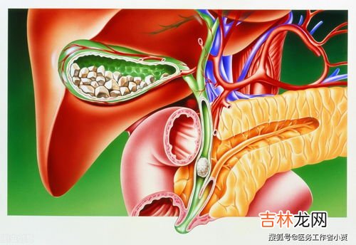 结石是怎样形成的,结石是怎么形成的？