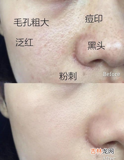 为什么会有闭口,闭口粉刺是什么原因引起的