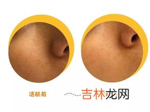 如何清洁毛孔的脏东西,毛孔里的垃圾怎么清理出来