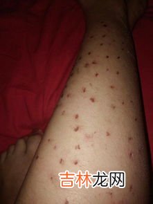 去除腿上皮屑小妙招,去除腿上皮屑小妙招如何去除腿上皮屑