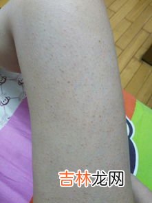 去除腿上皮屑小妙招,去除腿上皮屑小妙招如何去除腿上皮屑