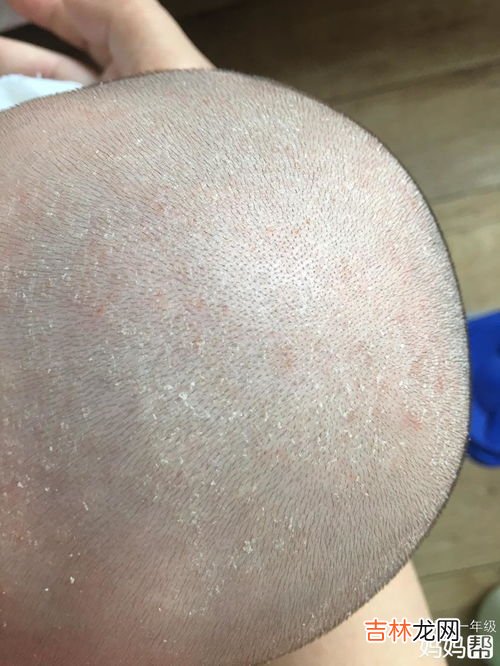 去除腿上皮屑小妙招,去除腿上皮屑小妙招如何去除腿上皮屑
