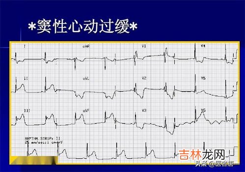 心率简写,频率是怎么计算的？