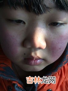 为什么脸会发红,脸发红是怎么回事