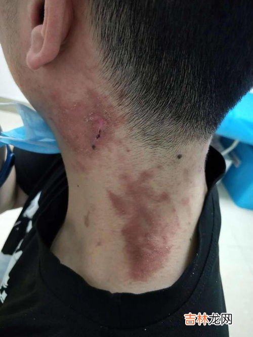 隐翅虫为什么很难捏死,屋里为什么会有隐翅虫怎么办
