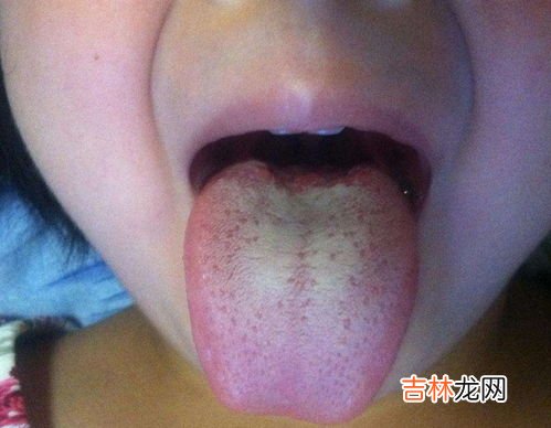 为什么舌头发白,舌苔发白是什么原因