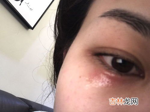 眼睛为什么痒,眼睛痒是什么原因引起的?