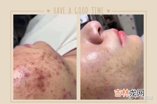 皮肤碰到硫酸怎么处理,硫酸滴在皮肤上怎么办