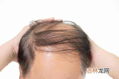 不洗头会掉头发吗,经常不洗头发可以防脱发，这个说法是真的吗？