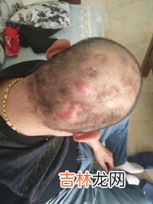 为什么有毛囊炎,毛囊炎的病因及诱因有哪些