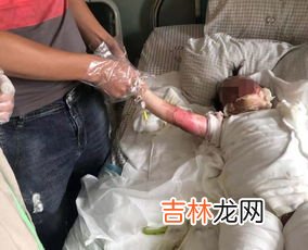 大面积烧伤的人有哪些痛苦,被火烧伤到底有多痛?