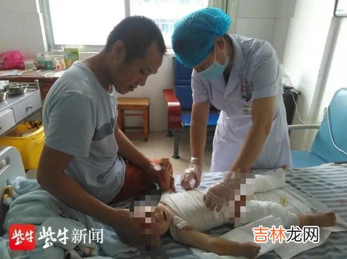 大面积烧伤的人有哪些痛苦,被火烧伤到底有多痛?