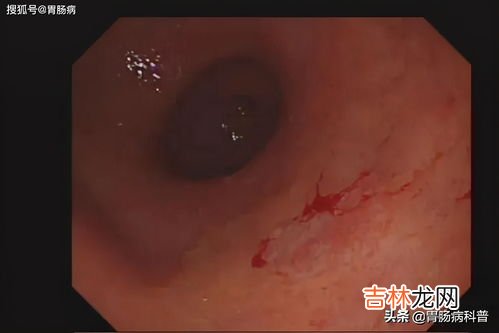 中国每年恶性肿瘤总人数大概是多少,中国每年死癌症的有多少
