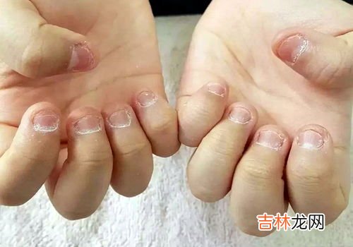 男孩啃秃10个指甲引发骨髓炎,孩子总是啃指甲是怎么回事?家长应该怎么防止宝宝啃指甲?