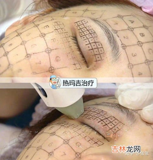 热玛吉的原理和功效,热玛吉是什么?做了有什么功效?