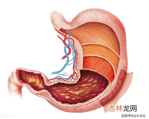 女生喝热水治胃痛半年后查出胃癌,宁波23岁姑娘胃疼2周没重视确诊胃癌，胃癌该如何预防？