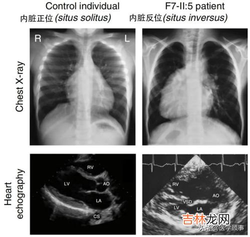 黑热病是什么,黑热病是通过什么传播的