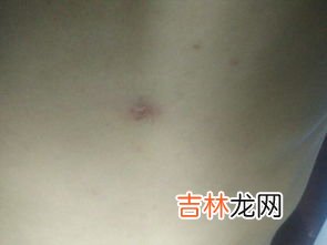 痘痘里面挤出来的白色东西是什么,痘痘里面挤出来的白色东西是什么？