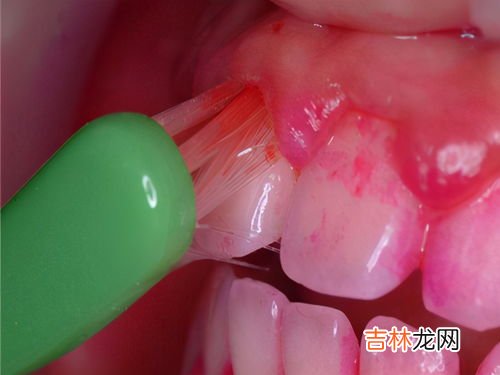 牙龈为什么会出血,牙龈出血是怎么回事啊?