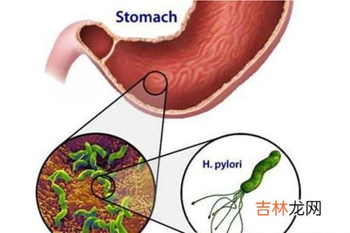 胃病会出现哪些症状,胃病有哪些症状表现？