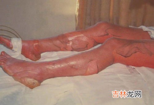 氯乙烯职业病,可能产生职业病危害的化学品材料有哪些?