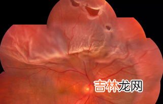 视网膜脱落能不能治疗,视网膜脱落能不能治疗好