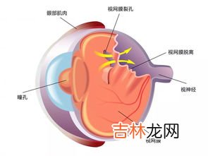 视网膜脱落能不能治疗,视网膜脱落能不能治疗好