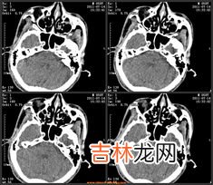 视网膜脱落能不能治疗,视网膜脱落能不能治疗好