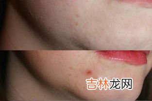 怎样疏通毛孔堵塞排出垃圾,怎么疏通脸上的毛孔