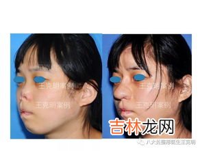 鼻子捏大后的补救方法有哪些,鼻子被捏扣的肿大怎么办