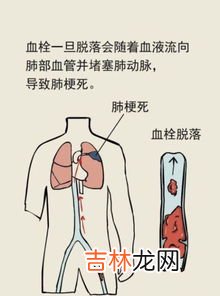 男子长期久坐后被诊断截瘫,长期久坐对身体都有哪些危害？如何避免久坐带来的危害？