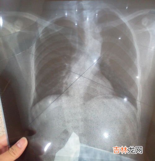 颈椎侧弯怎么矫正,脊椎侧弯如何治疗