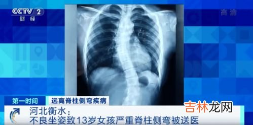 颈椎侧弯怎么矫正,脊椎侧弯如何治疗