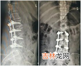 颈椎侧弯怎么矫正,脊椎侧弯如何治疗